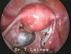 Endometriotic cyst of the left ovary (typical laparoscopic image).
